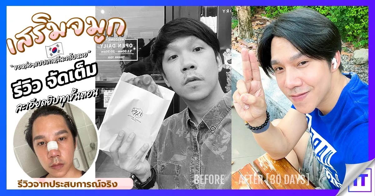 เสริมจมูกผู้ชาย Goodwill